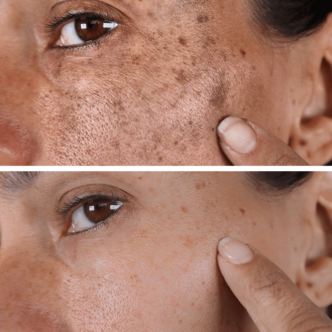 FerméLuxe Peel-Off Face Mask | Removes Sunspots & Pigmentation in Just 7 Days!