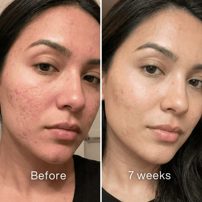 Cheapsu™ Clinical Acne Scar Remodeling Stick