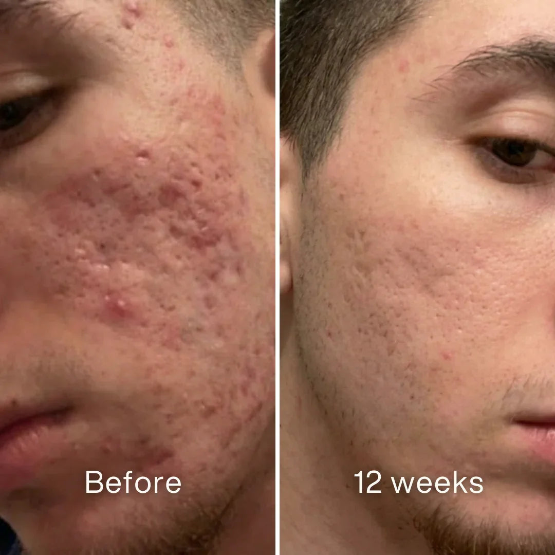 Cheapsu™ Clinical Acne Scar Remodeling Stick
