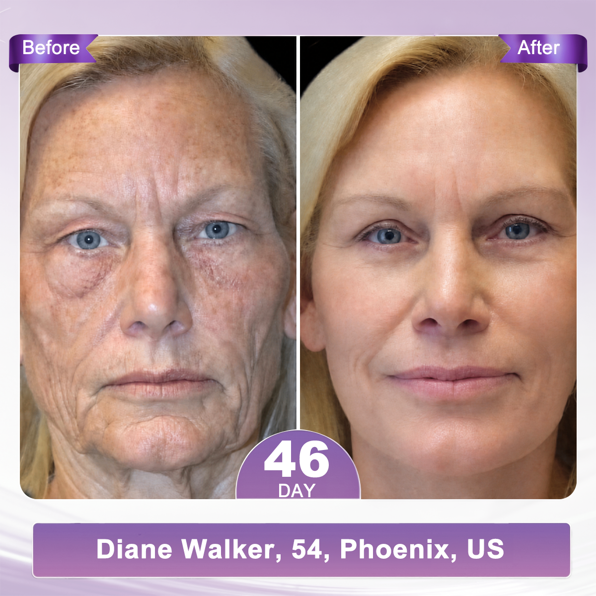 FDA Official: 𝐇𝐈𝐒𝐊𝐈𝐍® 𝐏𝐃𝐑𝐍 𝐌𝐮𝐥𝐭𝐢-𝐏𝐞𝐩𝐭𝐢𝐝𝐞 𝐌𝐚𝐬𝐬𝐚𝐠𝐢𝐧𝐠 𝐁𝐨𝐝𝐲 𝐑𝐨𝐥𝐥𝐞𝐫 𝐂𝐫𝐞𝐚𝐦- Anti-aging, Hydrating, Skin Firming & Lifting, Skin Repair, Even Tone, Acne and Dark Spot Treatment, Wart and Mole Removal, and Psoriasis Relief.