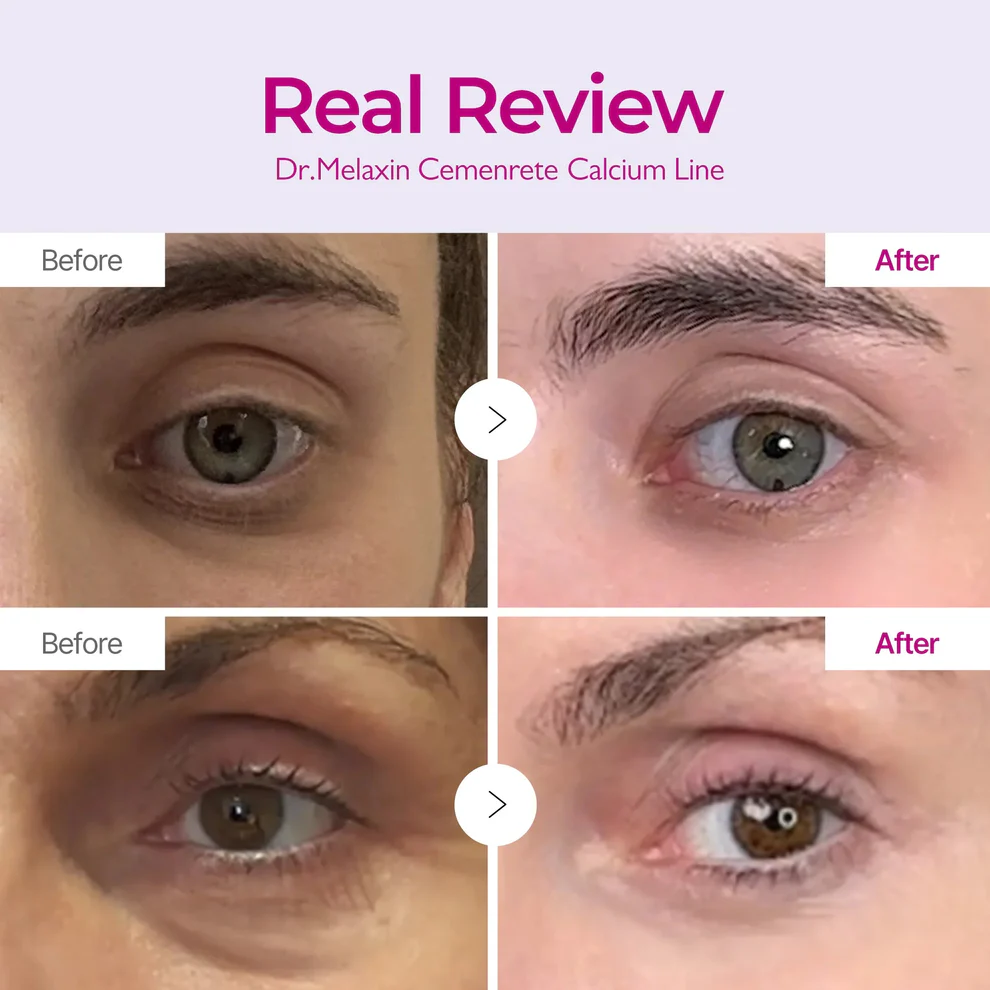 ✨ LAST DAY BUY 1 GET 1 FREE✨Cemenrete Calcium Dark Spot Eye Cream | Dark Circle, Anti-aging, Sagging, Elasticity